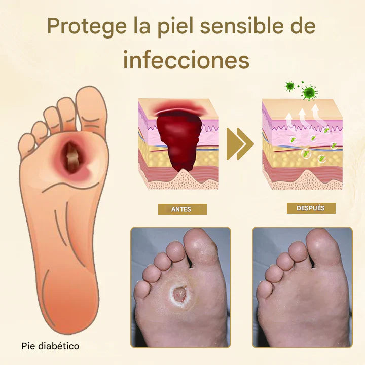 Timilk® Spray Curativo | Diabetes