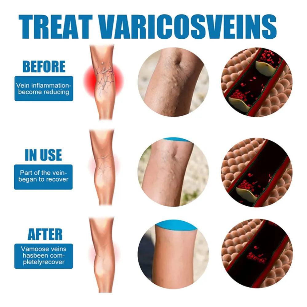 SPRAY VARICOSE VEINS x2 UND